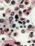 Mesenchymalis őssejtek felhasználása sérült porc pótlására