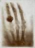 3.1 ábra: Röntgen első felvétele Az első felvétel a felesége, Anna Bertha Röntgen gyűrűs kezéről készült december 22-én.