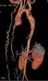ARTÉRIÁK BETEGSÉGEI. Rupturált abdominális aorta aneurysmák kezelésével kapcsolatos tapasztalataink