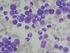 Lymphoma sejtvonalak és gyerekkori leukémia (ALL) sejtek mikro RNS (mir) profiljának vizsgálata